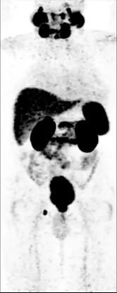 PSMA Gallium